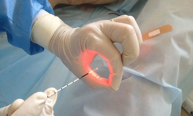 laserbehandeling voor prostatitis