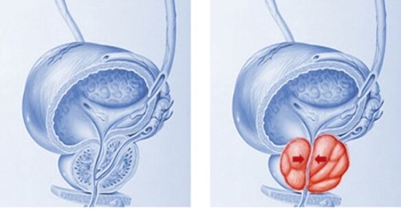 gezonde en ontstoken prostaat met prostatitis